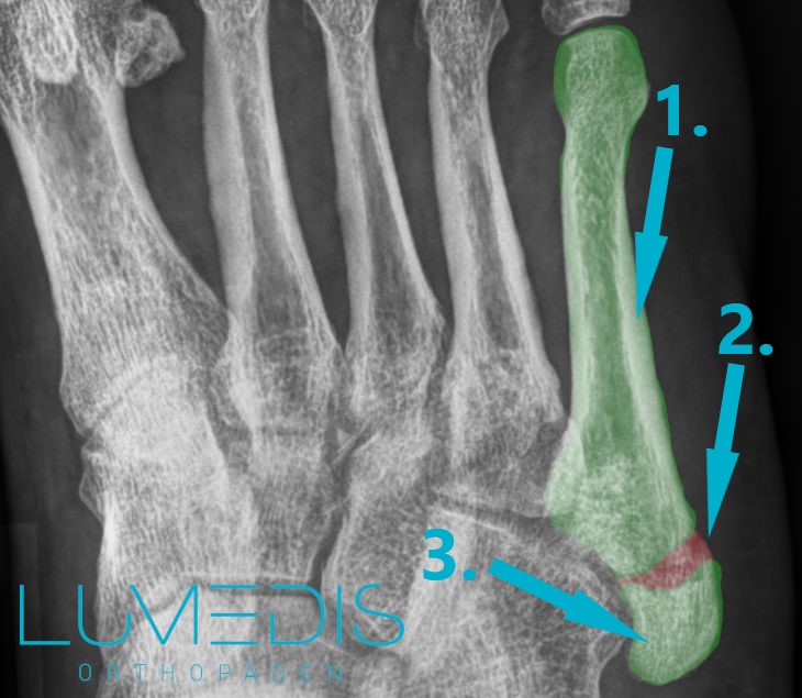 Röntgenbild MT5 Basisfraktur