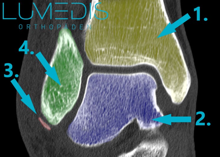 CT einer Knochenabsplitterung am Sprunggelenk (Fibula)