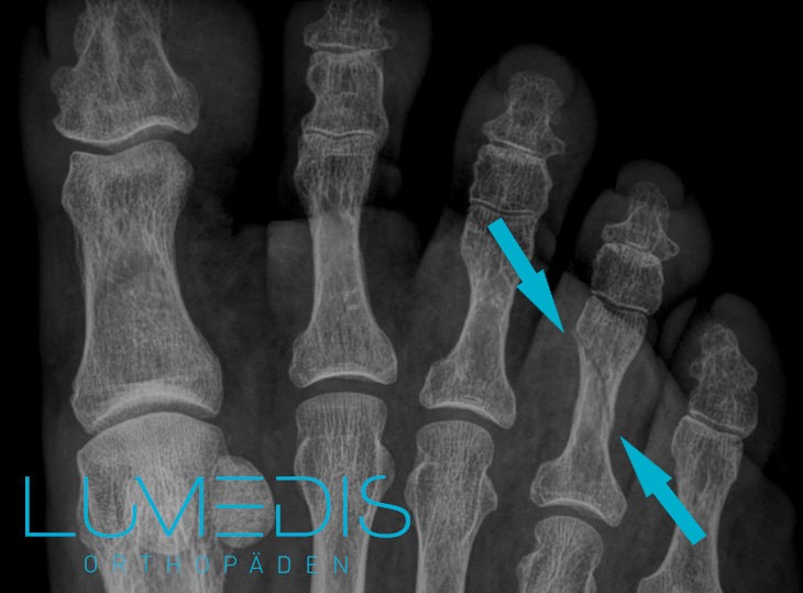Röntgenbild eines Bruch des 4. Zehs