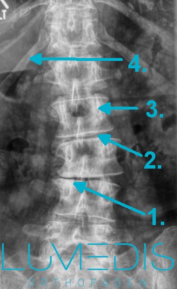 Skoliose der LWS - Röntgenbild