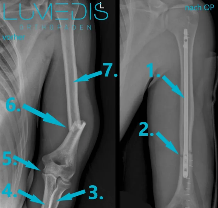Röntgenbild Oberarmbruch vorher und nachher mit Nagel im Oberarmknochen