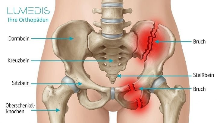 Abbildung eines Beckenbruchs