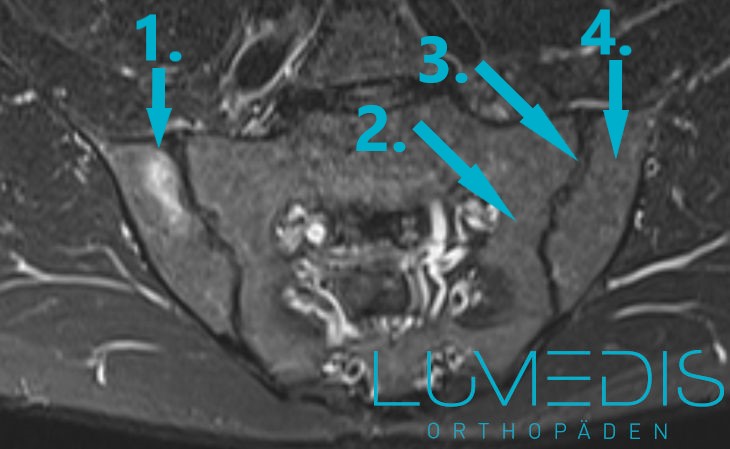 MRT einer floriden Sacroiliitis