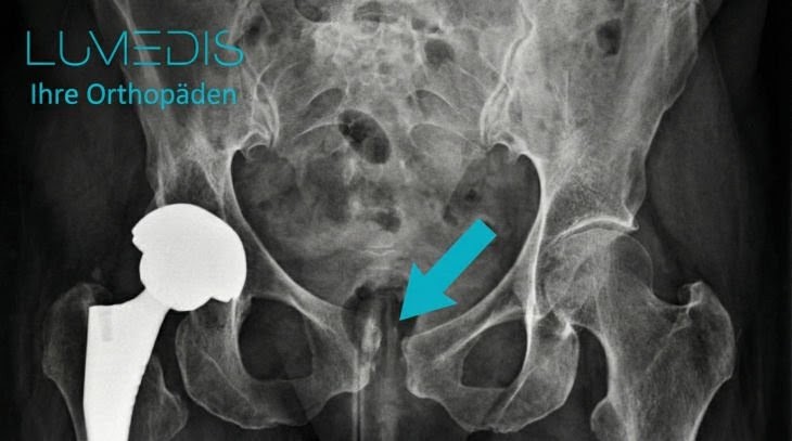 Röntgenbild einer Symphysenspregung