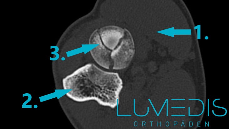CT einer Radiusköpfchenfraktur (Mehrfachbruch)