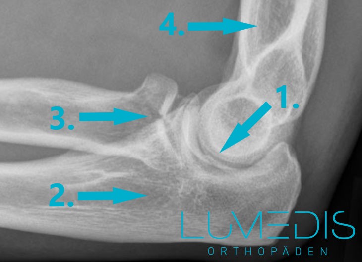 Röntgenbild einer Radiuskopffraktur von der Seite