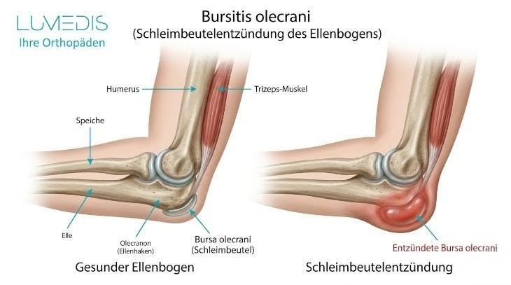 Abbildung Schleimbeutelentzündung im Ellenbogen