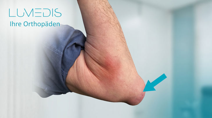 abakterielle Bursitis olecrani abakterielle Bursitis olecrani