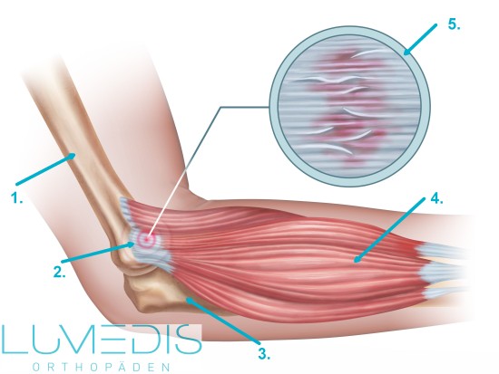 Erkrankung des Ellenbogens