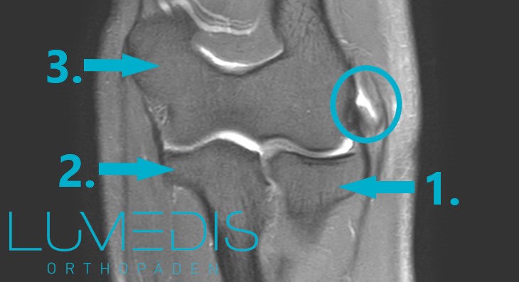 MRT Ellenbogen mit Teilriss der Extensorensehne beim Tennisarm