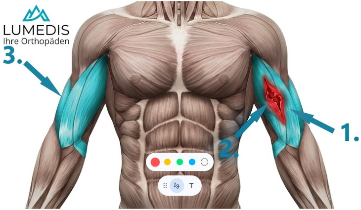 Muskelfaserriss im linken Bizeps