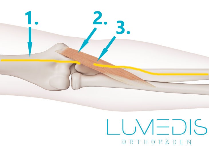 Pronator teres Syndrom Pronator teres Syndrom