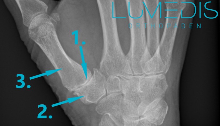 Röntgen einer Rhizarthrose (Arthrose im Daumen) der rechten Hand