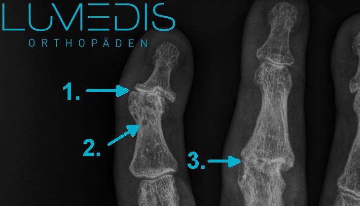 Heberdenarthrose