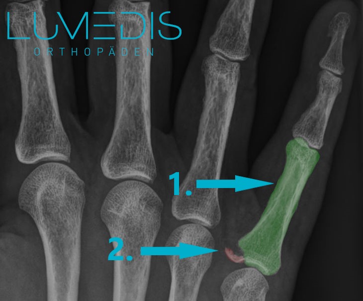 Knochenabsplitterung am Finger - Röntgenbild