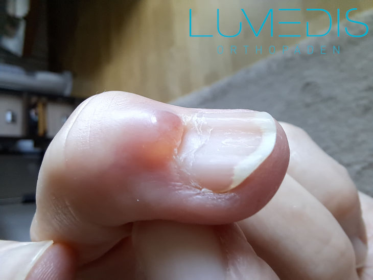 Mukoidzyste am Daumen