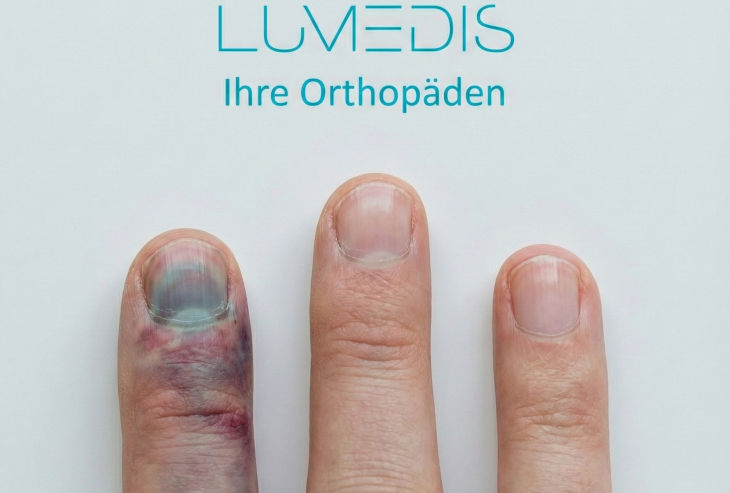 Zeigefinger der rechten Hand gequetscht Zeigefinger der rechten Hand gequetscht