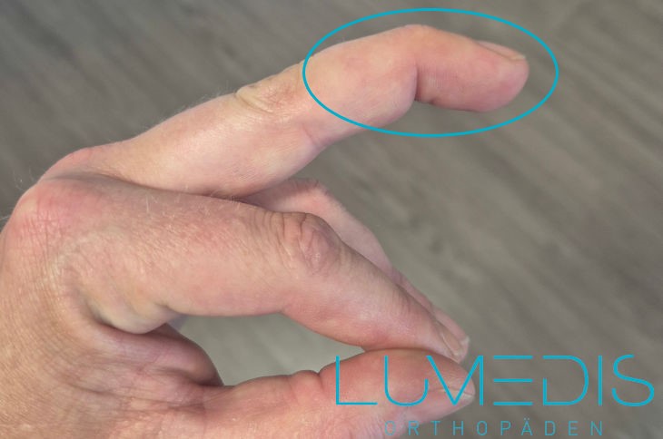 Strecksehnenriss vom linken Mittelfinger