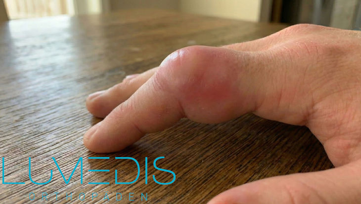 Finger ausgekugelt (Fingerluxation) Finger ausgekugelt (Fingerluxation)