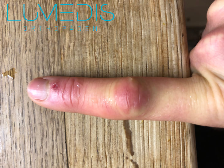 Finger geschwollen und entzündet