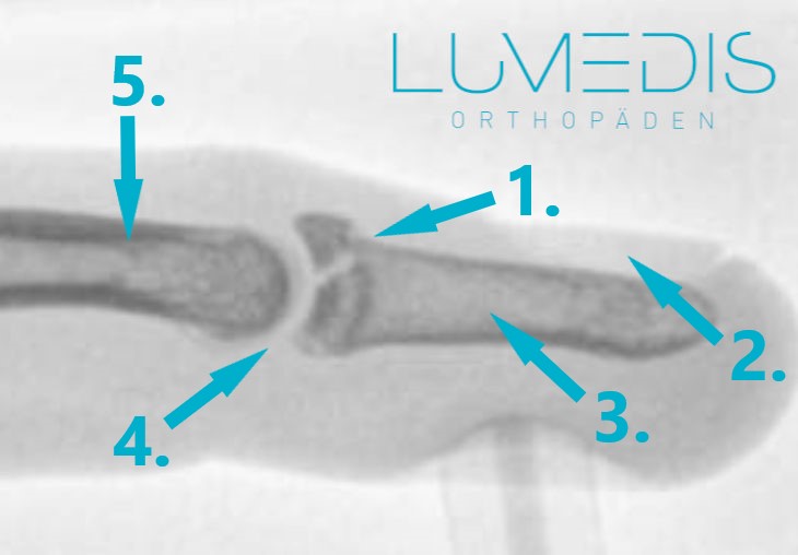 Röntgenbild eines gebrochenen Fingers