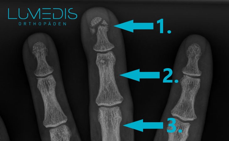 Röntgenbild eines gebrochenen Fingers