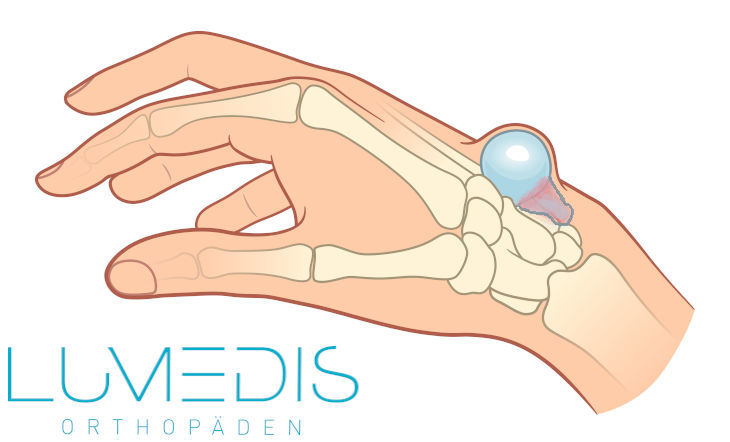 Ganglion Handgelenk geplatzt