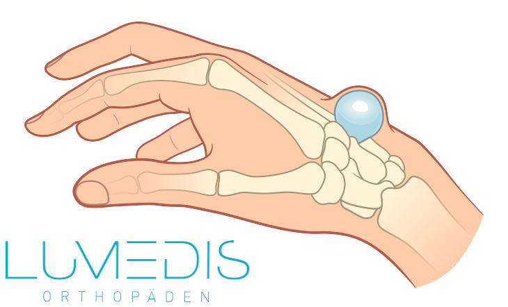 Ganglion am Handgelenk/Handrücken