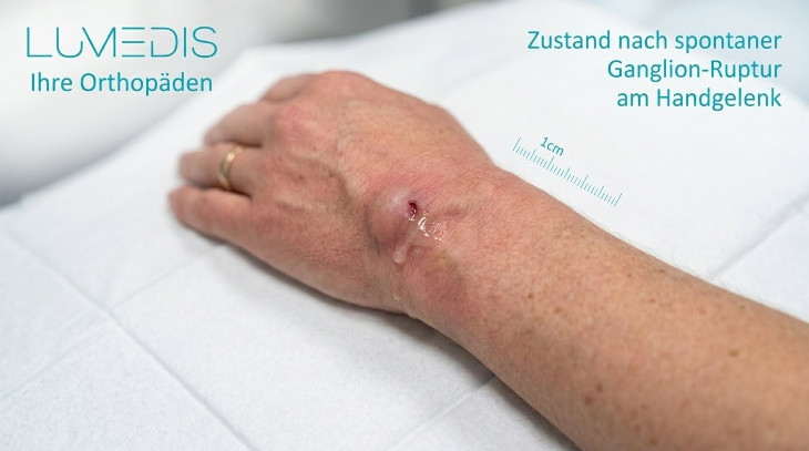 Ganglion am Handgelenk ist geplatzt Ganglion am Handgelenk ist geplatzt