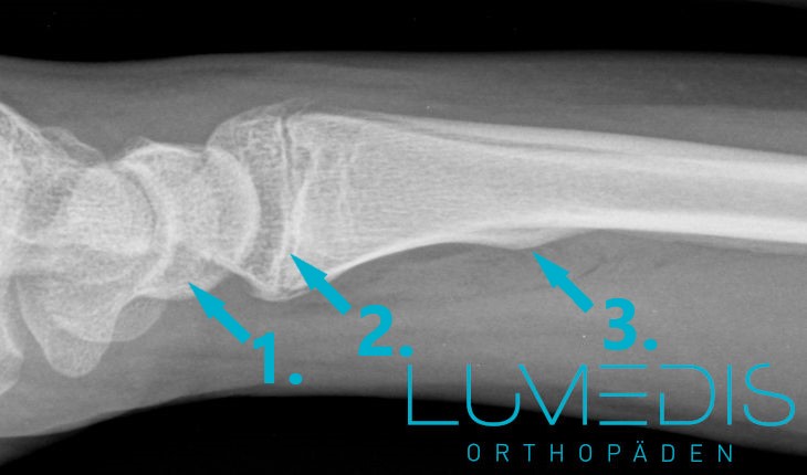 Röntgenbild eines Wulstbruchs am Handgelenk