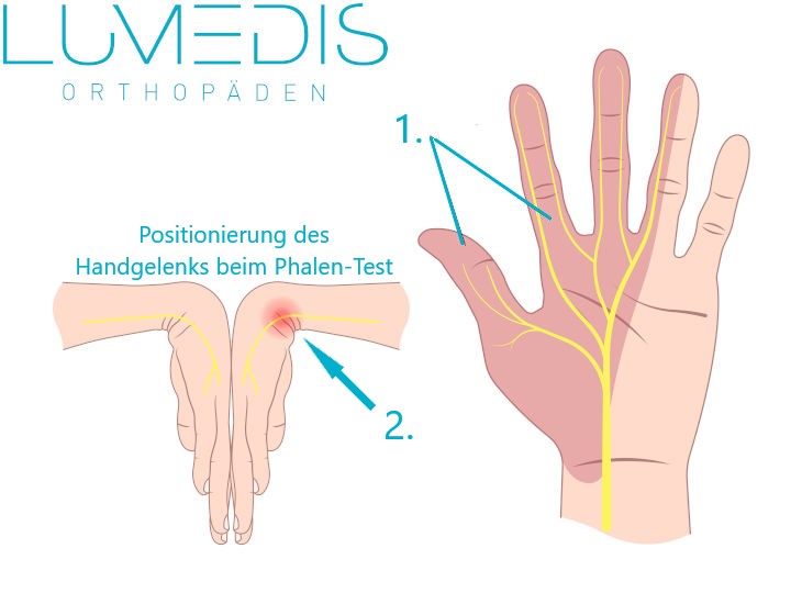 Phalen-Test bei einem Karpaltunnelsyndrom