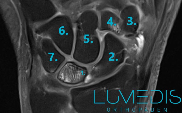 MRT einer Lunatummalazie links MRT einer Lunatummalazie links