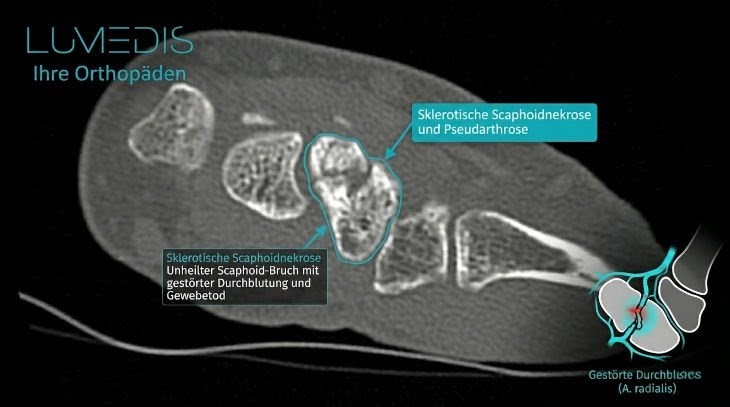 CT eines Morbus Preisers