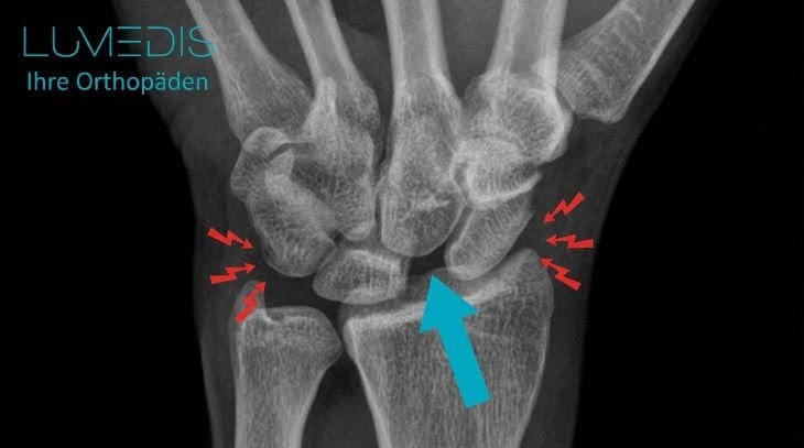 Röntgenbild einer scapholunäre Dissoziation (SLD)