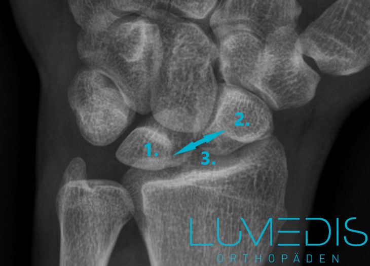 Röntgen einer SLD (scapholunären Dissoziation) Röntgen einer SLD (scapholunären Dissoziation)