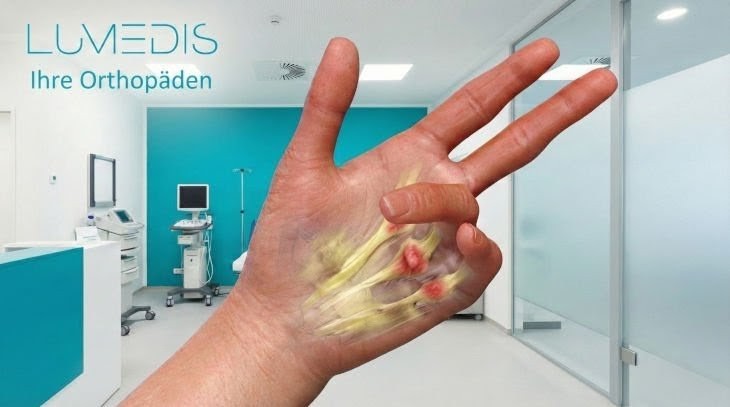 Morbus Dupytren - Lumedis - Handspezialisten