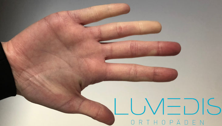 Raynaud Syndrom Raynaud Syndrom