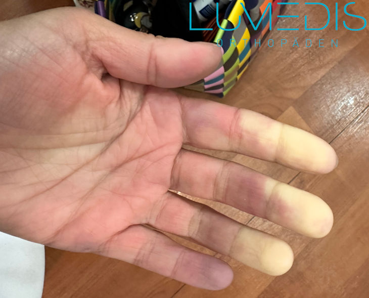 Raynaud-Syndrom der Finger