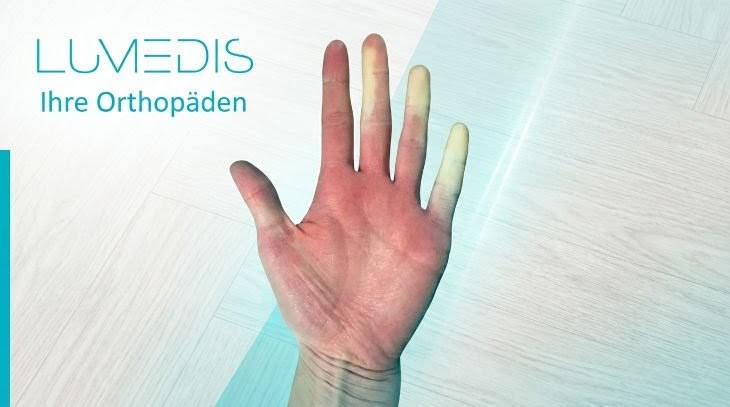 Morbus Raynaud in akuter Phase
