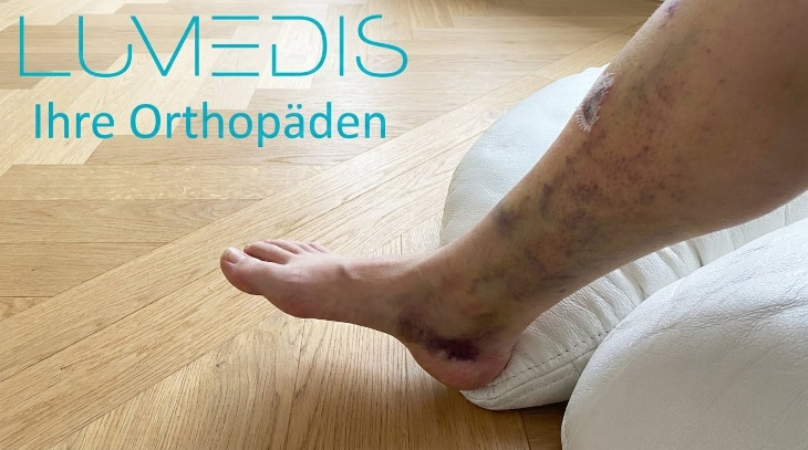 Schienbein geprellt mit Hämatom Schienbein geprellt mit Hämatom
