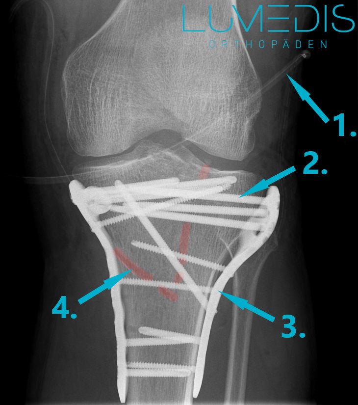 Röntgenbild einer Tibiakopffraktur mit Osteosynthese