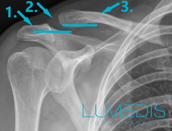 Schultereckgelenkssprengung Röntgenbild