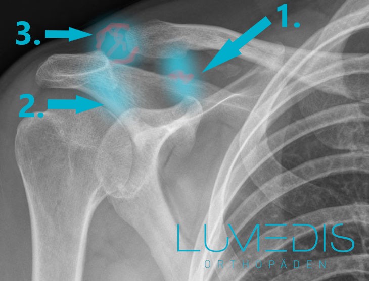 Schultereckgelenksprengung Röntgenbild