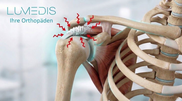Abbildung einer Kalkschulter in der Supraspinatussehne