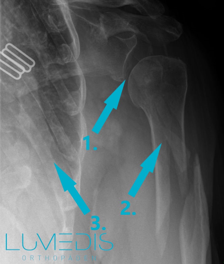 Röntgenbild eines Oberarmbruchs links