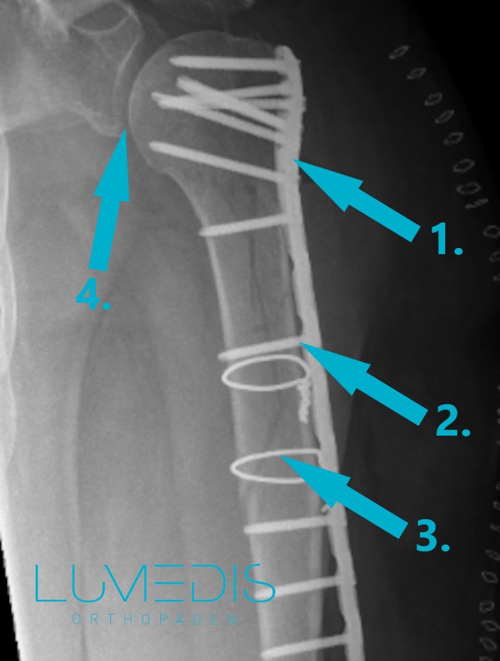 Röntgenbild eines Oberarmbruchs links mit Platte und Schrauben
