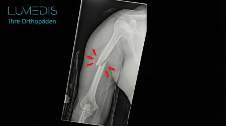 Röntgenbild eines Oberarmbruchs