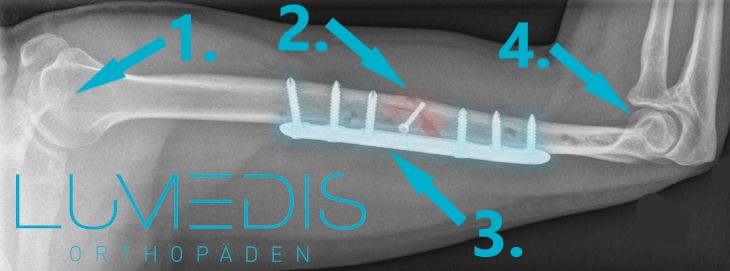 Röntgenbild mit Oberarmbruch und Platte