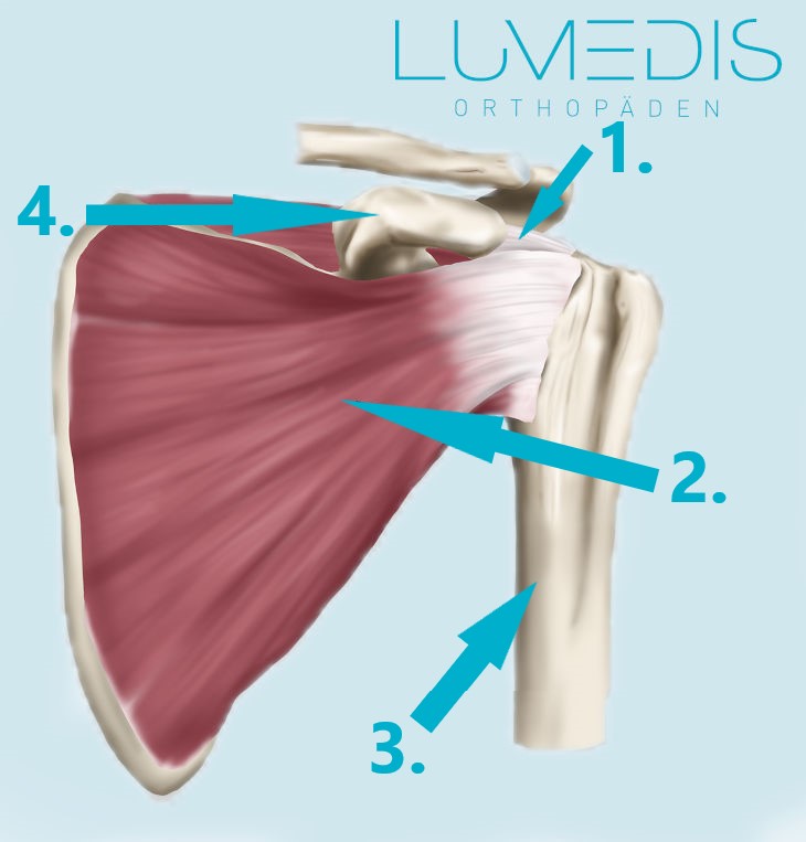 Riss (Ruptur) der Supraspinatussehne