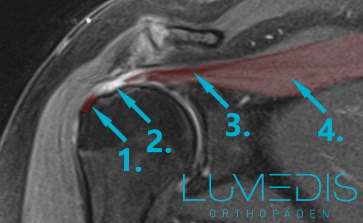 Riss (Ruptur) der Supraspinatussehne